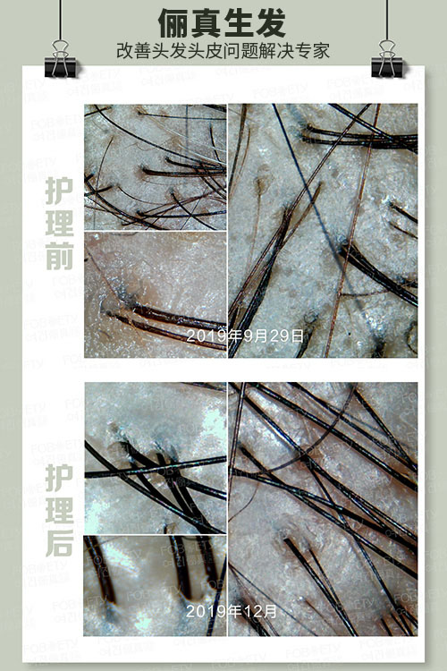 頭油、頭癢
