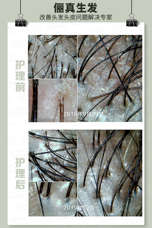 頭油、頭癢